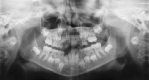 Dental Radiographs (X-Rays) - Pediatric Dentist in South Plainfield, NJ