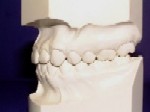 Class I - Malocclusion - Orthodontics in South Plainfield, NJ